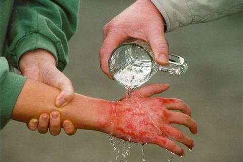 DRK. Verbrennung behandeln